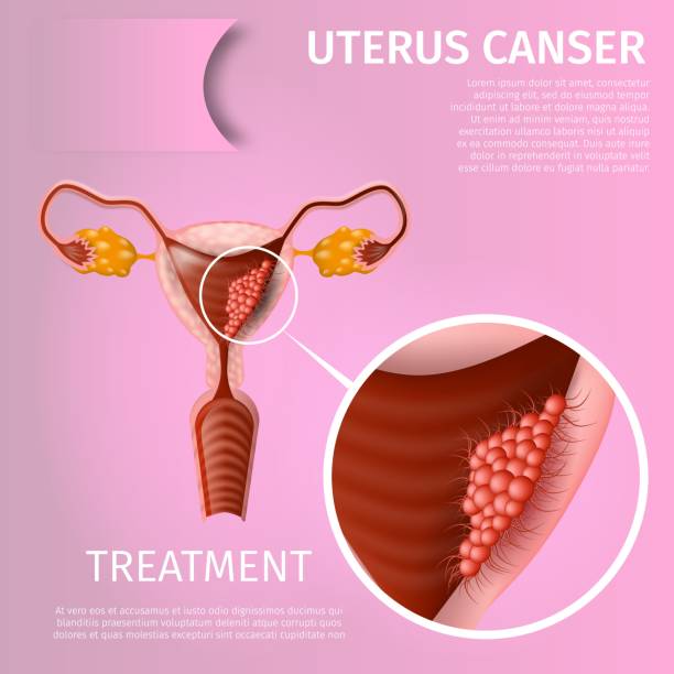 Gynec Cancer